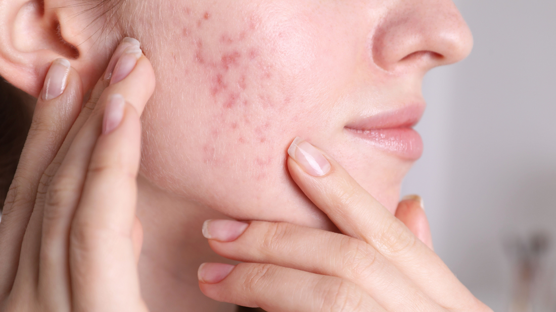 Throw away your tretinoin, here’s how to clear acne, naturally.