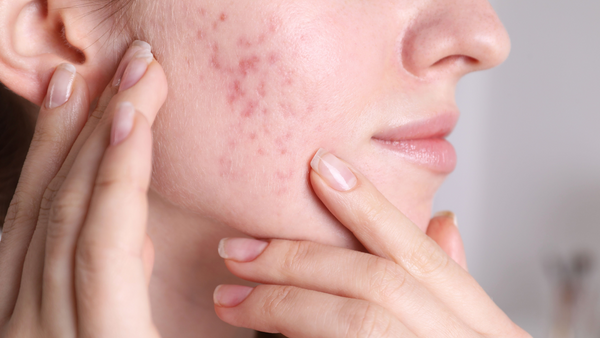 Throw away your tretinoin, here’s how to clear acne, naturally.