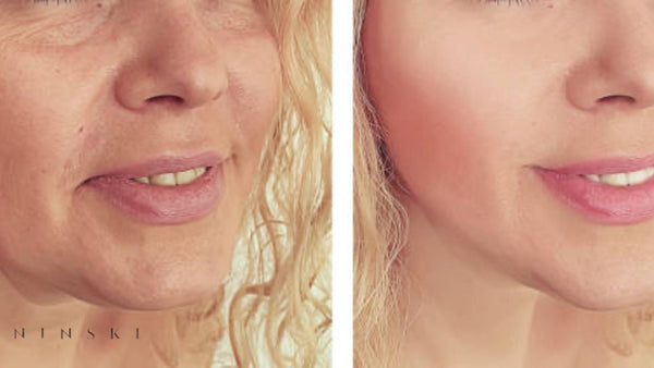 Transform Your Beauty Journey with HIFU Treatments at Ninski London