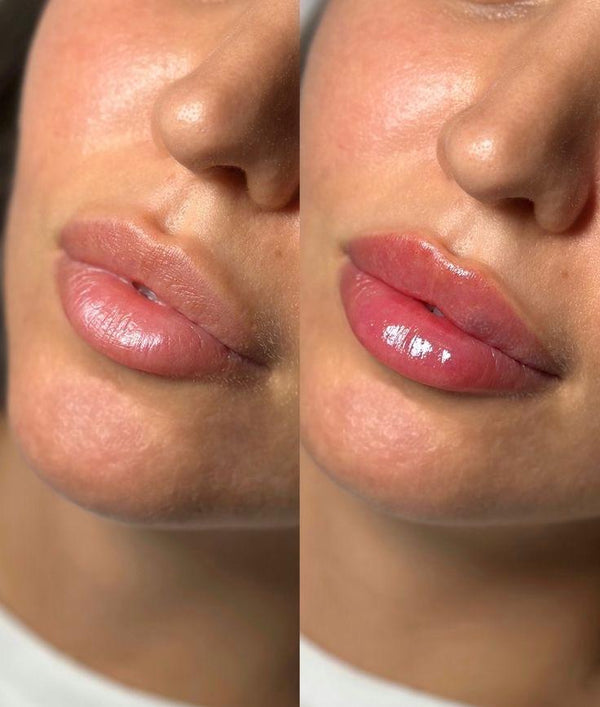 Transform Your Beauty Journey with HIFU Treatments at Ninski London