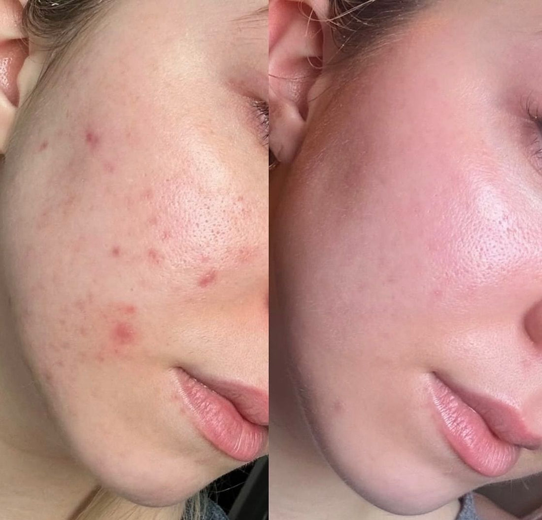 Throw away your tretinoin, here’s how to clear acne, naturally.