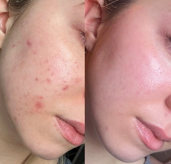 Throw away your tretinoin, here’s how to clear acne, naturally.