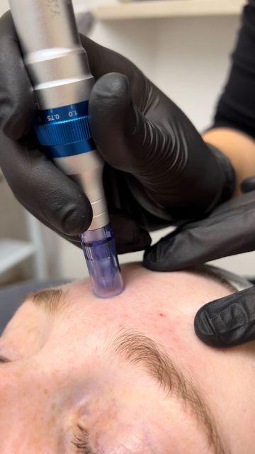 Microneedling Training (1 day course)