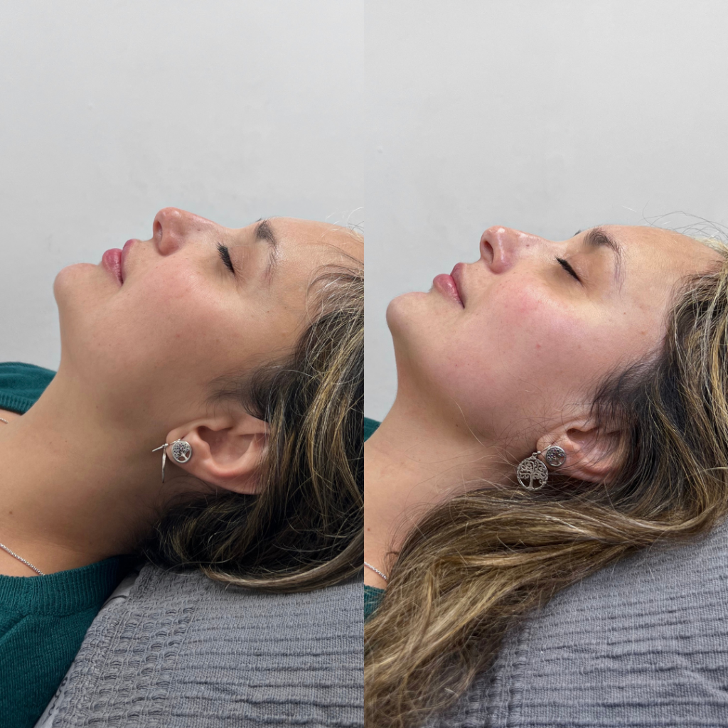 A before and after photo of a woman's face before and after she received a HIFU facial. In the after photo, her jawline is much more defined and apparent. Her face looks much slimmer in the after photo.