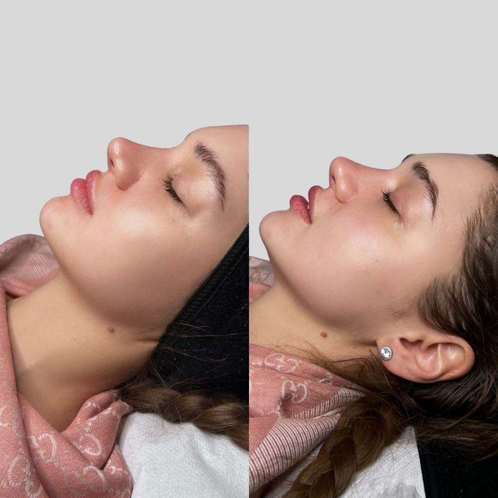 A before and after photo of a woman's face before and after she received a HIFU facial. In the after photo, her jawline is much more defined and apparent. Her face looks much slimmer in the after photo.